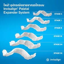 Invisalign Palatal Expanderの画像